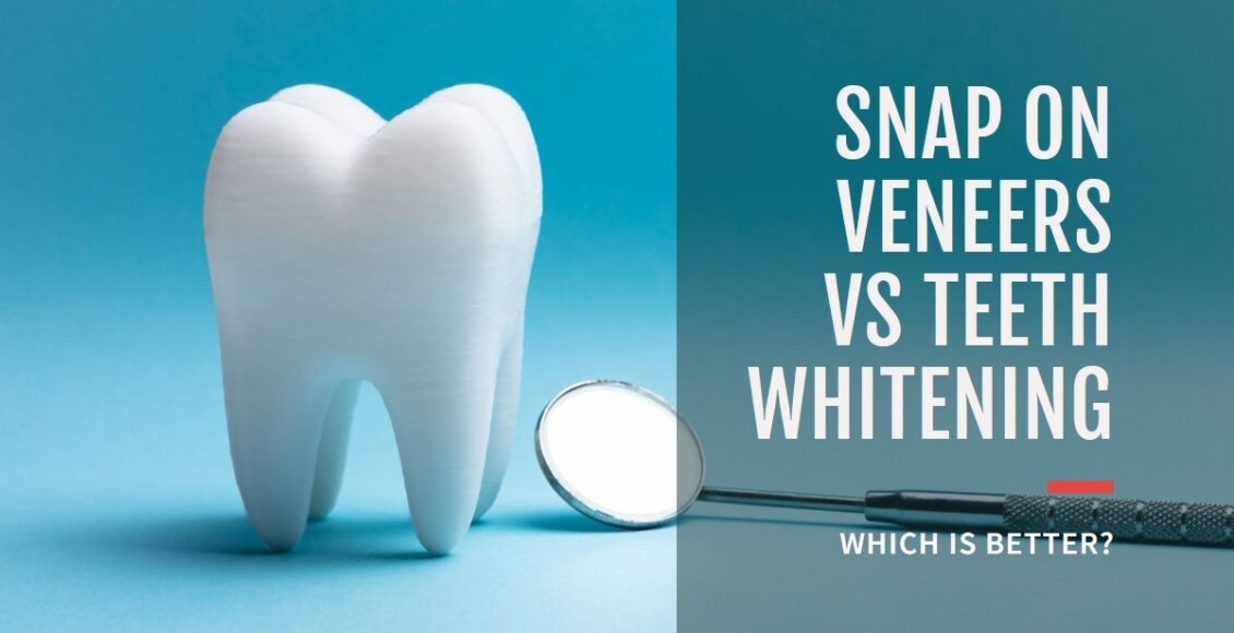 Better Snap on Veneers Or Teeth Whitening