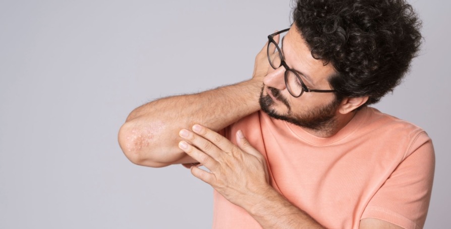 eczema treatment